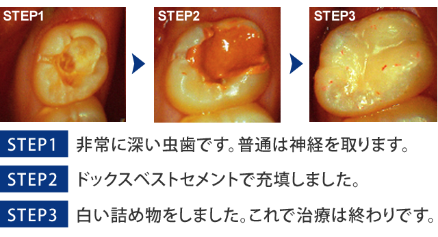 神戸 薬で治す虫歯治療 ドックスベストセメント アートセンター歯科